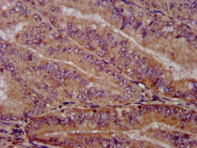 PPP2R4 Antibody - IHC image of PPP2R4 Antibody diluted at 1:1000 and staining in paraffin-embedded human endometrial cancer performed on a Leica BondTM system. After dewaxing and hydration, antigen retrieval was mediated by high pressure in a citrate buffer (pH 6.0). Section was blocked with 10% normal goat serum 30min at RT. Then primary antibody (1% BSA) was incubated at 4°C overnight. The primary is detected by a biotinylated secondary antibody and visualized using an HRP conjugated SP system.