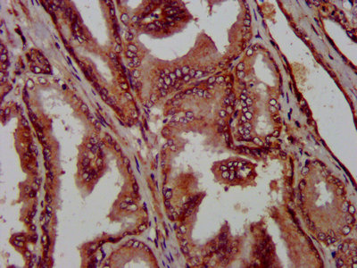 PPP2R4 Antibody - IHC image of PPP2R4 Antibody diluted at 1:1000 and staining in paraffin-embedded human prostate tissue performed on a Leica BondTM system. After dewaxing and hydration, antigen retrieval was mediated by high pressure in a citrate buffer (pH 6.0). Section was blocked with 10% normal goat serum 30min at RT. Then primary antibody (1% BSA) was incubated at 4°C overnight. The primary is detected by a biotinylated secondary antibody and visualized using an HRP conjugated SP system.