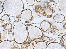 PPP2R4 Antibody - Immunohistochemistry of paraffin-embedded Human thyroid cancer tissue  using PTPA Polyclonal Antibody at dilution of 1:50(×200)