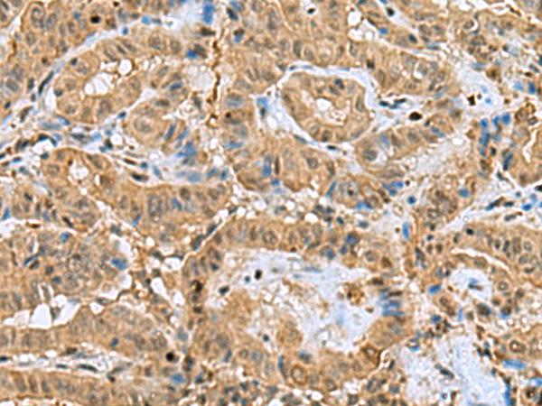 PPP2R4 Antibody - Immunohistochemistry of paraffin-embedded Human thyroid cancer tissue  using PTPA Polyclonal Antibody at dilution of 1:60(×200)