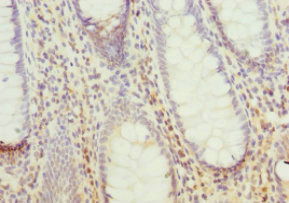 PPP2R5C Antibody - Immunohistochemistry of paraffin-embedded human colon cancer at dilution 1:100