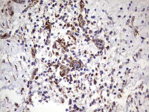 PPP2R5D Antibody - IHC of paraffin-embedded Carcinoma of Human pancreas tissue using anti-PPP2R5D mouse monoclonal antibody. (Heat-induced epitope retrieval by 1 mM EDTA in 10mM Tris, pH8.5, 120°C for 3min).