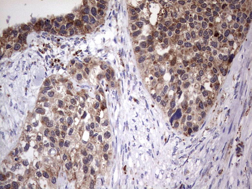 PPP2R5D Antibody - IHC of paraffin-embedded Carcinoma of Human kidney tissue using anti-PPP2R5D mouse monoclonal antibody. (Heat-induced epitope retrieval by 1 mM EDTA in 10mM Tris, pH8.5, 120°C for 3min).