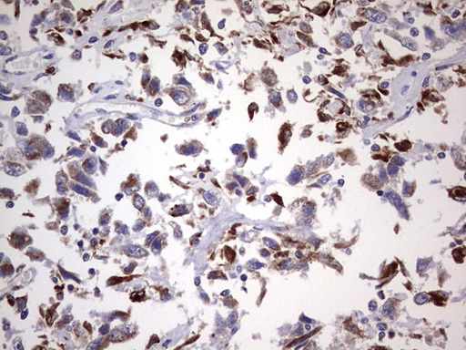 PPP2R5D Antibody - IHC of paraffin-embedded Adenocarcinoma of Human ovary tissue using anti-PPP2R5D mouse monoclonal antibody. (Heat-induced epitope retrieval by 1 mM EDTA in 10mM Tris, pH8.5, 120°C for 3min).
