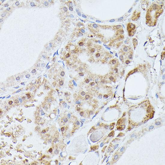 PPP2R5D Antibody - Immunohistochemistry of paraffin-embedded Human thyroid cancer using PPP2R5D Polyclonal Antibody at dilution of 1:100 (40x lens).