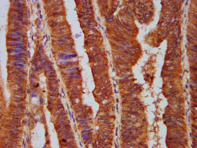 PPP2R5E Antibody - Immunohistochemistry Dilution at 1:500 and staining in paraffin-embedded human colon cancer performed on a Leica BondTM system. After dewaxing and hydration, antigen retrieval was mediated by high pressure in a citrate buffer (pH 6.0). Section was blocked with 10% normal Goat serum 30min at RT. Then primary antibody (1% BSA) was incubated at 4°C overnight. The primary is detected by a biotinylated Secondary antibody and visualized using an HRP conjugated SP system.