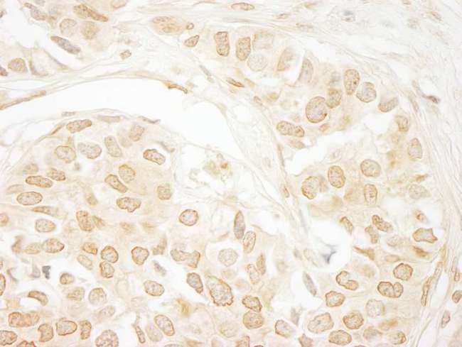 PPP3CA / CCN1 / Calcineurin A Antibody - Detection of Human PPP3CA by Immunohistochemistry. Sample: FFPE section of human breast carcinoma. Antibody: Affinity purified rabbit anti-PPP3CA used at a dilution of 1:1000 (1 ug/ml). Detection: DAB.