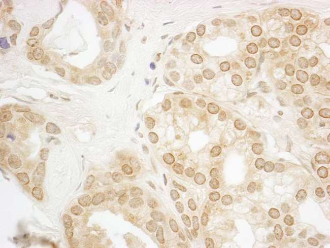 PPP3CA / CCN1 / Calcineurin A Antibody - Detection of Human PPP3CA by Immunohistochemistry. Sample: FFPE section of human prostate carcinoma. Antibody: Affinity purified rabbit anti-PPP3CA used at a dilution of 1:250. Epitope Retrieval Buffer-High pH (IHC-101J) was substituted for Epitope Retrieval Buffer-Reduced pH.