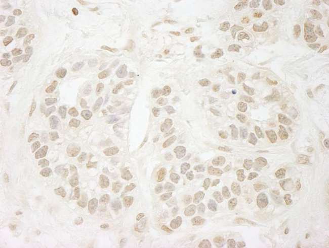 PPP3CA / CCN1 / Calcineurin A Antibody - Detection of Human PPP3CA by Immunohistochemistry. Sample: FFPE section of human breast carcinoma. Antibody: Affinity purified rabbit anti-PPP3CA used at a dilution of 1:250. Epitope Retrieval Buffer-High pH (IHC-101J) was substituted for Epitope Retrieval Buffer-Reduced pH.