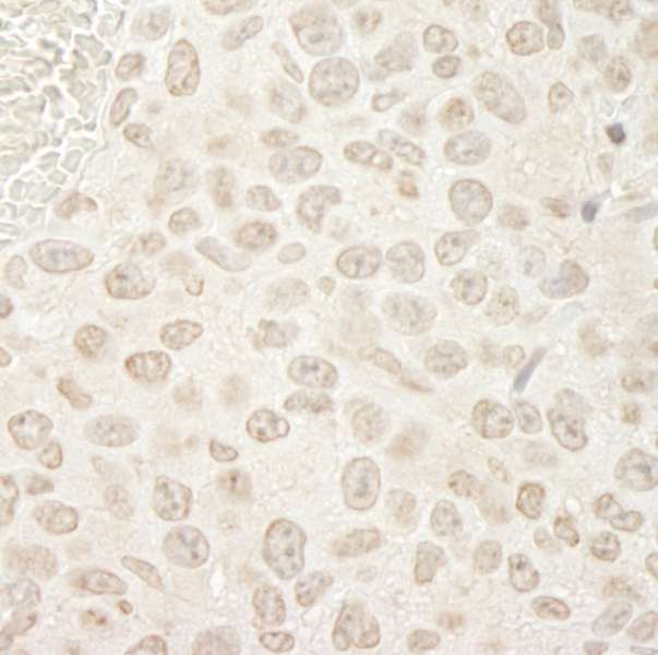 PPP3CA / CCN1 / Calcineurin A Antibody - Detection of Mouse PPP3CA by Immunohistochemistry. Sample: FFPE section of mouse colon carcinoma. Antibody: Affinity purified rabbit anti-PPP3CA used at a dilution of 1:250. Epitope Retrieval Buffer-High pH (IHC-101J) was substituted for Epitope Retrieval Buffer-Reduced pH.
