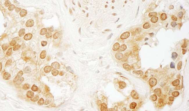 PPP3CA / CCN1 / Calcineurin A Antibody - Detection of Human PPP3CA by Immunohistochemistry. Sample: FFPE section of human prostate carcinoma. Antibody: Affinity purified rabbit anti-PPP3CA used at a dilution of 1:1000 (1 ug/ml). Detection: DAB.