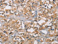 PPP3CA / CCN1 / Calcineurin A Antibody - Immunohistochemistry of paraffin-embedded Human thyroid cancer using PPP3CA Polyclonal Antibody at dilution of 1:30.