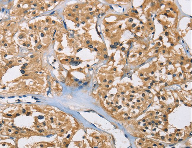 PPP3CA / CCN1 / Calcineurin A Antibody - Immunohistochemistry of paraffin-embedded Human thyroid cancer using PPP3CA Polyclonal Antibody at dilution of 1:40.