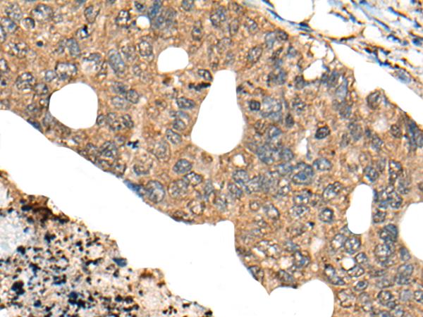 PPP3R1 / Calcineurin B Antibody - Immunohistochemistry of paraffin-embedded Human colorectal cancer tissue  using PPP3R1 Polyclonal Antibody at dilution of 1:80(×200)