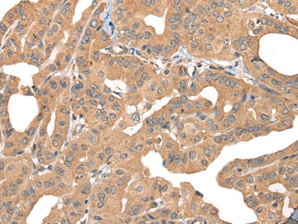 PPP3R1 / Calcineurin B Antibody - Immunohistochemistry of paraffin-embedded Human thyroid cancer tissue  using PPP3R1 Polyclonal Antibody at dilution of 1:55(×200)