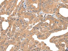 PPP3R1 / Calcineurin B Antibody - Immunohistochemistry of paraffin-embedded Human thyroid cancer tissue  using PPP3R1 Polyclonal Antibody at dilution of 1:55(×200)
