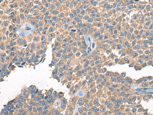 PPP3R1 / Calcineurin B Antibody - Immunohistochemistry of paraffin-embedded Human ovarian cancer tissue  using PPP3R1 Polyclonal Antibody at dilution of 1:55(×200)