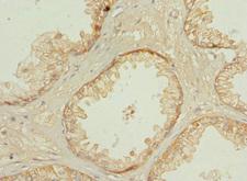 PPP3R2 Antibody - Immunohistochemistry of paraffin-embedded human prostate cancer at dilution 1:100