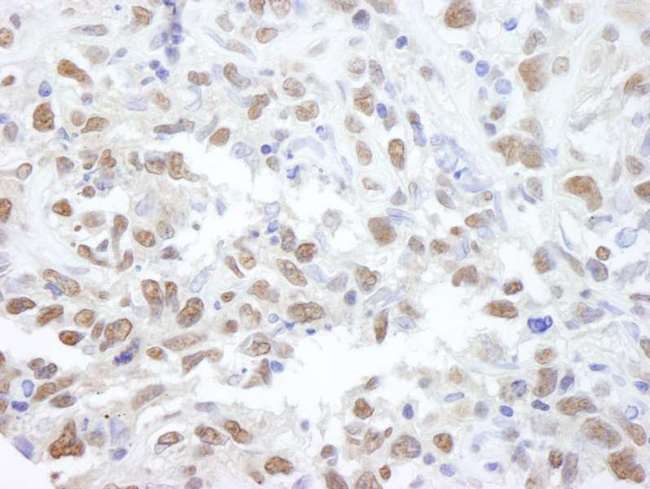 PPP4C Antibody - Detection of Human PPP4C by Immunohistochemistry. Sample: FFPE section of human metastatic lymph node. Antibody: Affinity purified rabbit anti-PPP4C used at a dilution of 1:500.