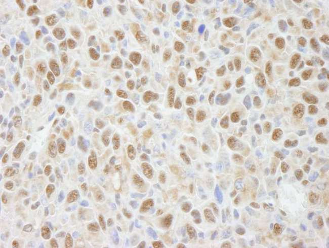 PPP4C Antibody - Detection of Mouse PPP4C by Immunohistochemistry. Sample: FFPE section of mouse squamous cell carcinoma. Antibody: Affinity purified rabbit anti-PPP4C used at a dilution of 1:100.