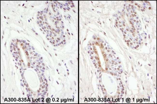 PPP4C Antibody - Detection of Human PPP4C by Immunohistochemistry. Samples: FFPE serial sections of human prostate carcinoma. Antibody: Affinity purified rabbit anti-PPP4C used at a dilution of 1:1000 (0.2 ug/ml). Detection: DAB.