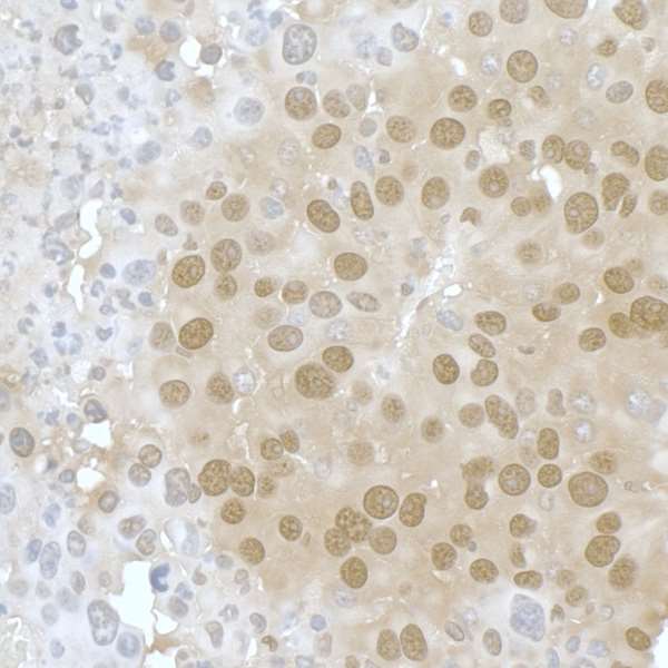 PPP4C Antibody - Detection of mouse PPP4C by immunohistochemistry. Sample: FFPE sections of mouse renal cell carcinoma. Antibody: Affinity purified rabbit anti- PPP4C used at a dilution of 1:200 (1µg/ml). Detection: DAB