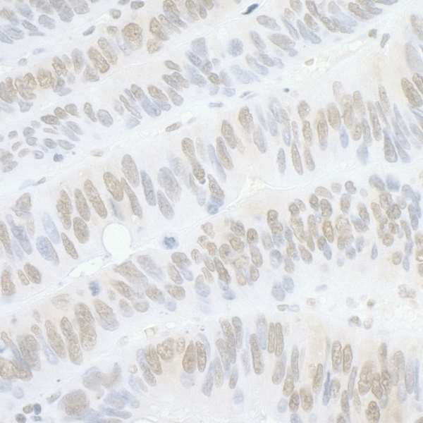 PPP4C Antibody - Detection of human PPP4C by immunohistochemistry. Sample: FFPE sections of human colon carcinoma. Antibody: Affinity purified rabbit anti- PPP4C used at a dilution of 1:1,000 (0.2 µg/ml). Detection: DAB