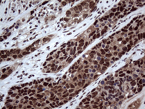 PPP4C Antibody - Immunohistochemical staining of paraffin-embedded Carcinoma of Human lung tissue using anti-PPP4C mouse monoclonal antibody. (Heat-induced epitope retrieval by 1mM EDTA in 10mM Tris buffer. (pH8.5) at 120°C for 3 min. (1:2000)