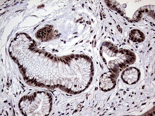 PPP4C Antibody - Immunohistochemical staining of paraffin-embedded Carcinoma of Human pancreas tissue using anti-PPP4C mouse monoclonal antibody. (Heat-induced epitope retrieval by 1mM EDTA in 10mM Tris buffer. (pH8.5) at 120°C for 3 min. (1:2000)