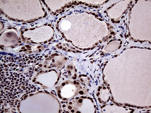 PPP4C Antibody - Immunohistochemical staining of paraffin-embedded Human thyroid tissue within the normal limits using anti-PPP4C mouse monoclonal antibody. (Heat-induced epitope retrieval by 1mM EDTA in 10mM Tris buffer. (pH8.5) at 120°C for 3 min. (1:2000)