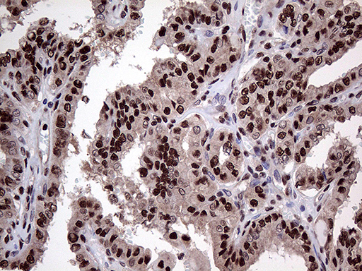 PPP4C Antibody - Immunohistochemical staining of paraffin-embedded Carcinoma of Human thyroid tissue using anti-PPP4C mouse monoclonal antibody. (Heat-induced epitope retrieval by 1mM EDTA in 10mM Tris buffer. (pH8.5) at 120°C for 3 min. (1:2000)