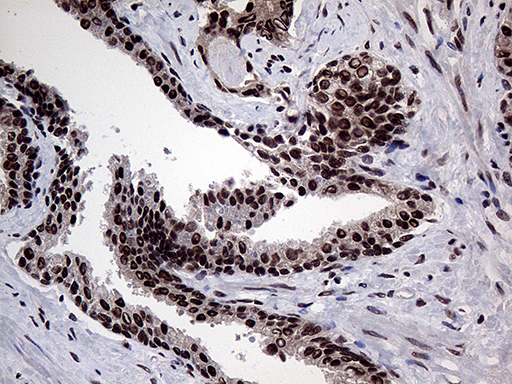 PPP4C Antibody - Immunohistochemical staining of paraffin-embedded Carcinoma of Human prostate tissue using anti-PPP4C mouse monoclonal antibody. (Heat-induced epitope retrieval by 1mM EDTA in 10mM Tris buffer. (pH8.5) at 120°C for 3 min. (1:2000)