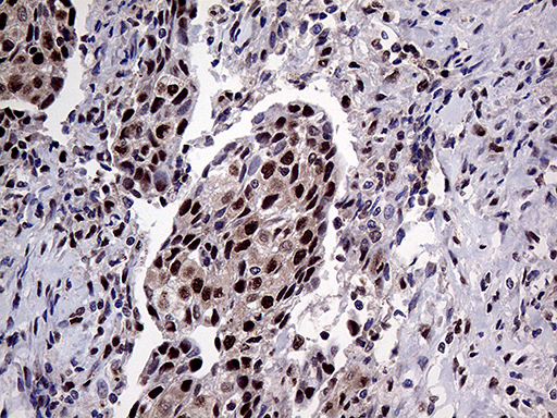 PPP4C Antibody - Immunohistochemical staining of paraffin-embedded Carcinoma of Human bladder tissue using anti-PPP4C mouse monoclonal antibody. (Heat-induced epitope retrieval by 1mM EDTA in 10mM Tris buffer. (pH8.5) at 120°C for 3 min. (1:2000)