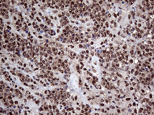 PPP4C Antibody - Immunohistochemical staining of paraffin-embedded Human lymphoma tissue using anti-PPP4C mouse monoclonal antibody. (Heat-induced epitope retrieval by 1mM EDTA in 10mM Tris buffer. (pH8.5) at 120°C for 3 min. (1:2000)