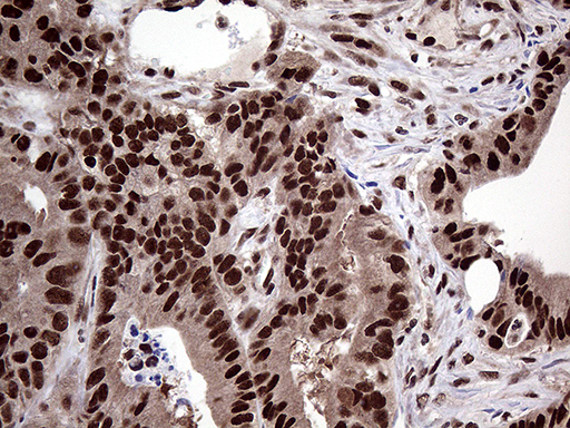 PPP4C Antibody - Immunohistochemical staining of paraffin-embedded Adenocarcinoma of Human colon tissue using anti-PPP4C mouse monoclonal antibody. (Heat-induced epitope retrieval by 1mM EDTA in 10mM Tris buffer. (pH8.5) at 120°C for 3 min. (1:2000)