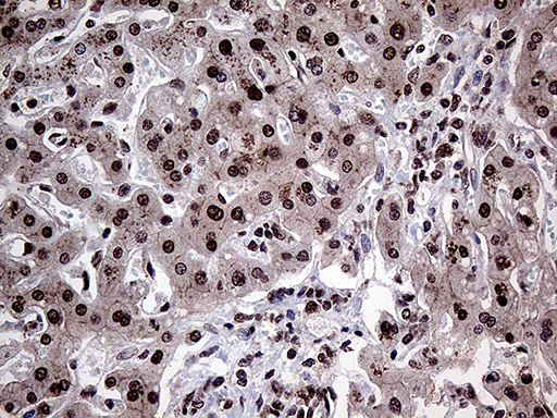 PPP4C Antibody - Immunohistochemical staining of paraffin-embedded Carcinoma of Human liver tissue using anti-PPP4C mouse monoclonal antibody. (Heat-induced epitope retrieval by 1mM EDTA in 10mM Tris buffer. (pH8.5) at 120°C for 3 min. (1:2000)