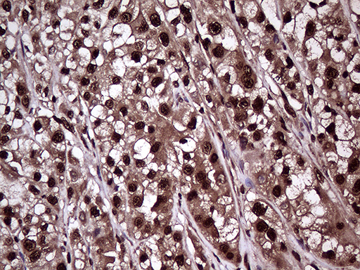 PPP4C Antibody - Immunohistochemical staining of paraffin-embedded Carcinoma of Human kidney tissue using anti-PPP4C mouse monoclonal antibody. (Heat-induced epitope retrieval by 1mM EDTA in 10mM Tris buffer. (pH8.5) at 120°C for 3 min. (1:2000)