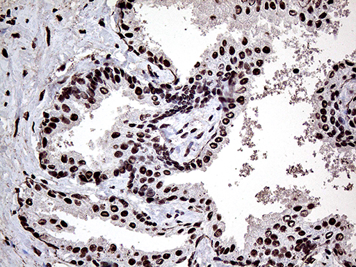 PPP4C Antibody - Immunohistochemical staining of paraffin-embedded Carcinoma of Human prostate tissue using anti-PPP4C mouse monoclonal antibody. (Heat-induced epitope retrieval by 1mM EDTA in 10mM Tris buffer. (pH8.5) at 120°C for 3 min. (1:2000)