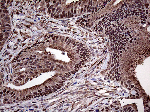 PPP4C Antibody - Immunohistochemical staining of paraffin-embedded Adenocarcinoma of Human colon tissue using anti-PPP4C mouse monoclonal antibody. (Heat-induced epitope retrieval by 1mM EDTA in 10mM Tris buffer. (pH8.5) at 120°C for 3 min. (1:2000)