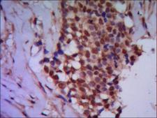 PPP4C Antibody - IHC of paraffin-embedded human breast cancer using anti-Protein Phosphatase 4C mouse monoclonal antibody diluted 1/500-1/1000.