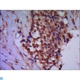 PPP4C Antibody - IHC of paraffin-embedded human breast cancer using anti-Protein Phosphatase 4C mouse mAb diluted 1:500-1:1000.