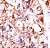 PPP5C Antibody - Formalin-fixed and paraffin-embedded human cancer tissue reacted with the primary antibody, which was peroxidase-conjugated to the secondary antibody, followed by AEC staining. This data demonstrates the use of this antibody for immunohistochemistry; clinical relevance has not been evaluated. BC = breast carcinoma; HC = hepatocarcinoma.