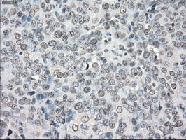 PPP5C Antibody - IHC of paraffin-embedded Adenocarcinoma of ovary tissue using anti-PPP5C mouse monoclonal antibody. (Dilution 1:50).