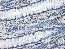 PPP5C Antibody - IHC of paraffin-embedded Adenocarcinoma of colon tissue using anti-PPP5C mouse monoclonal antibody. (Dilution 1:50).