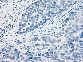 PPP5C Antibody - Immunohistochemical staining of paraffin-embedded Adenocarcinoma of ovary tissue using anti-PPP5C mouse monoclonal antibody. (Dilution 1:50).