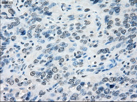 PPP5C Antibody - Immunohistochemical staining of paraffin-embedded Carcinoma of bladder tissue using anti-PPP5C mouse monoclonal antibody. (Dilution 1:50).