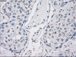 PPP5C Antibody - Immunohistochemical staining of paraffin-embedded Adenocarcinoma of breast tissue using anti-PPP5C mouse monoclonal antibody. (Dilution 1:50).