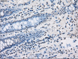 PPP5C Antibody - Immunohistochemical staining of paraffin-embedded Adenocarcinoma of colon tissue using anti-PPP5C mouse monoclonal antibody. (Dilution 1:50).