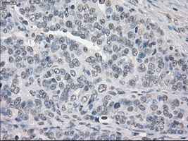 PPP5C Antibody - Immunohistochemical staining of paraffin-embedded Adenocarcinoma of ovary tissue using anti-PPP5C mouse monoclonal antibody. (Dilution 1:50).