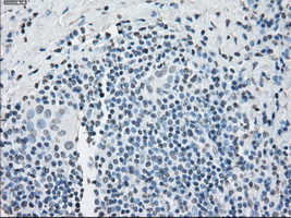 PPP5C Antibody - Immunohistochemical staining of paraffin-embedded Carcinoma of thyroid tissue using anti-PPP5C mouse monoclonal antibody. (Dilution 1:50).
